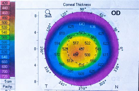 optical corneal pachymetry test